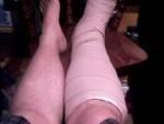 <img0*113:stuff/Broke_Ankle.jpg>